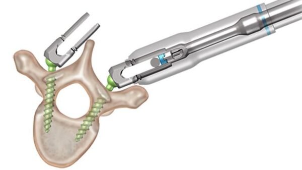 EXPEDIUM VERSE® Spinal System 2